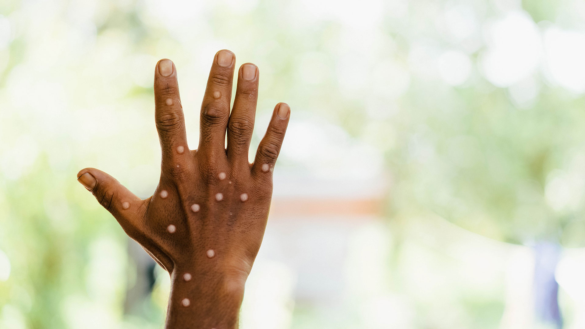 An image of a man's hand with pox blisters.